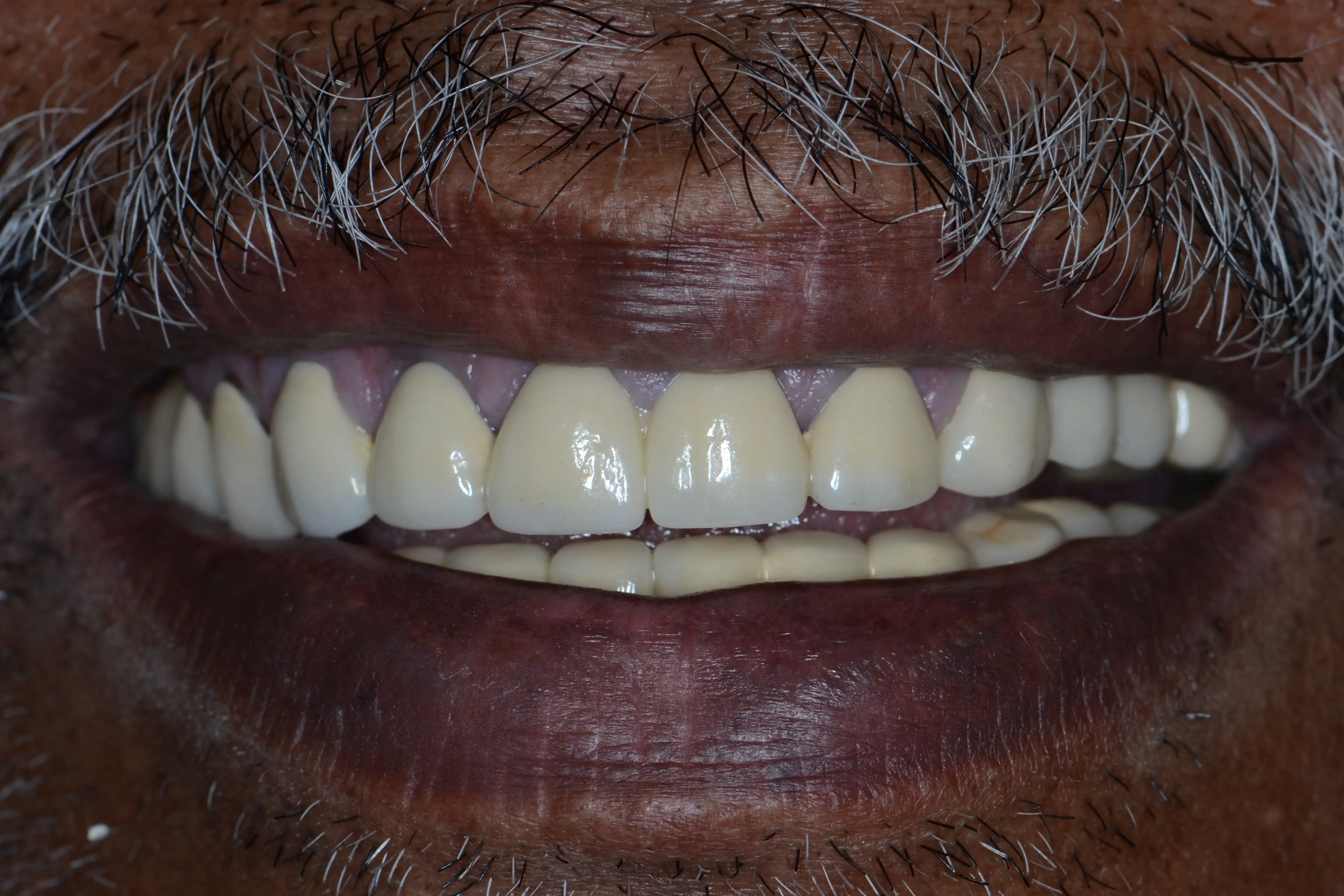 After treatment