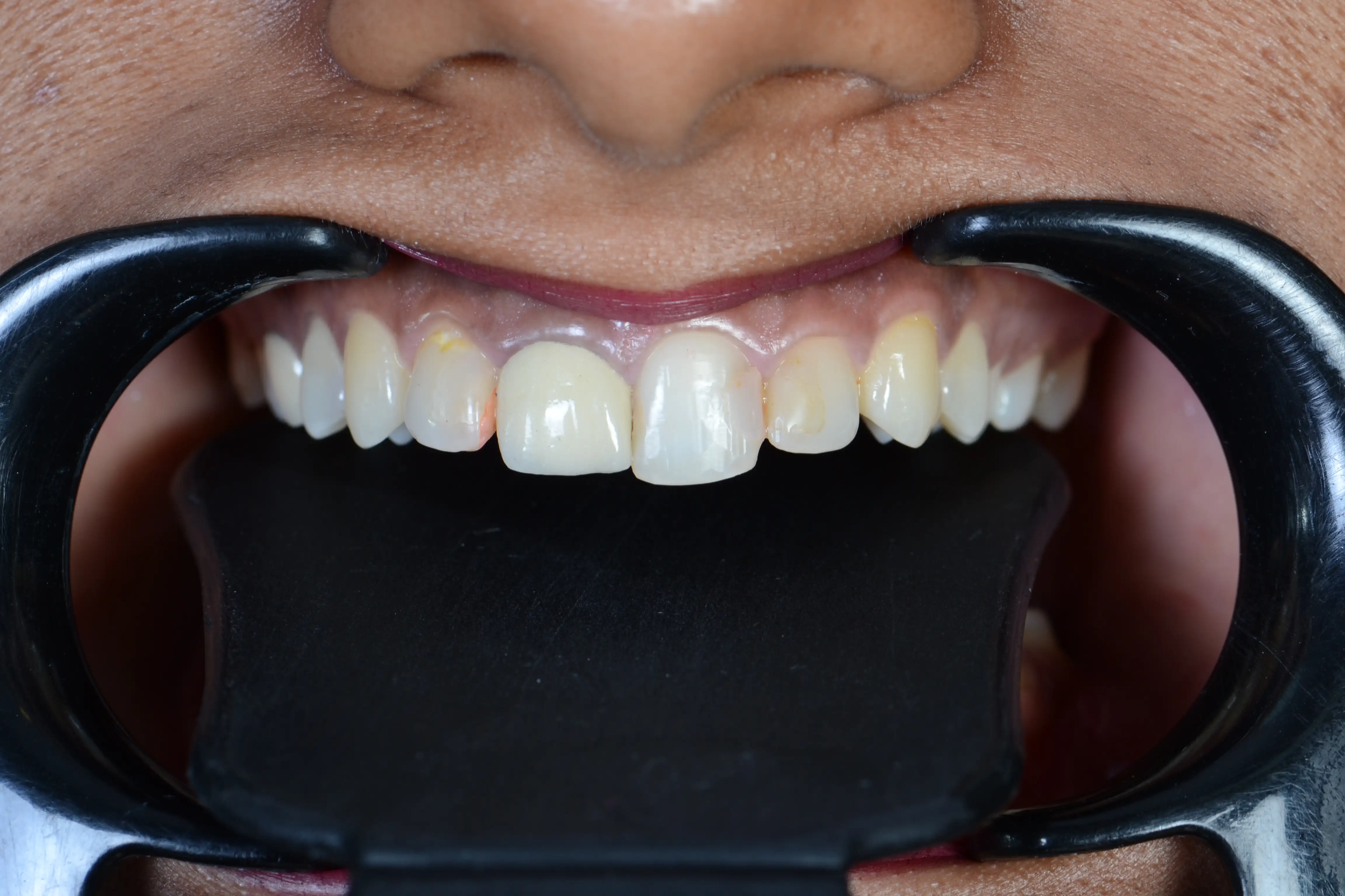 Before treatment