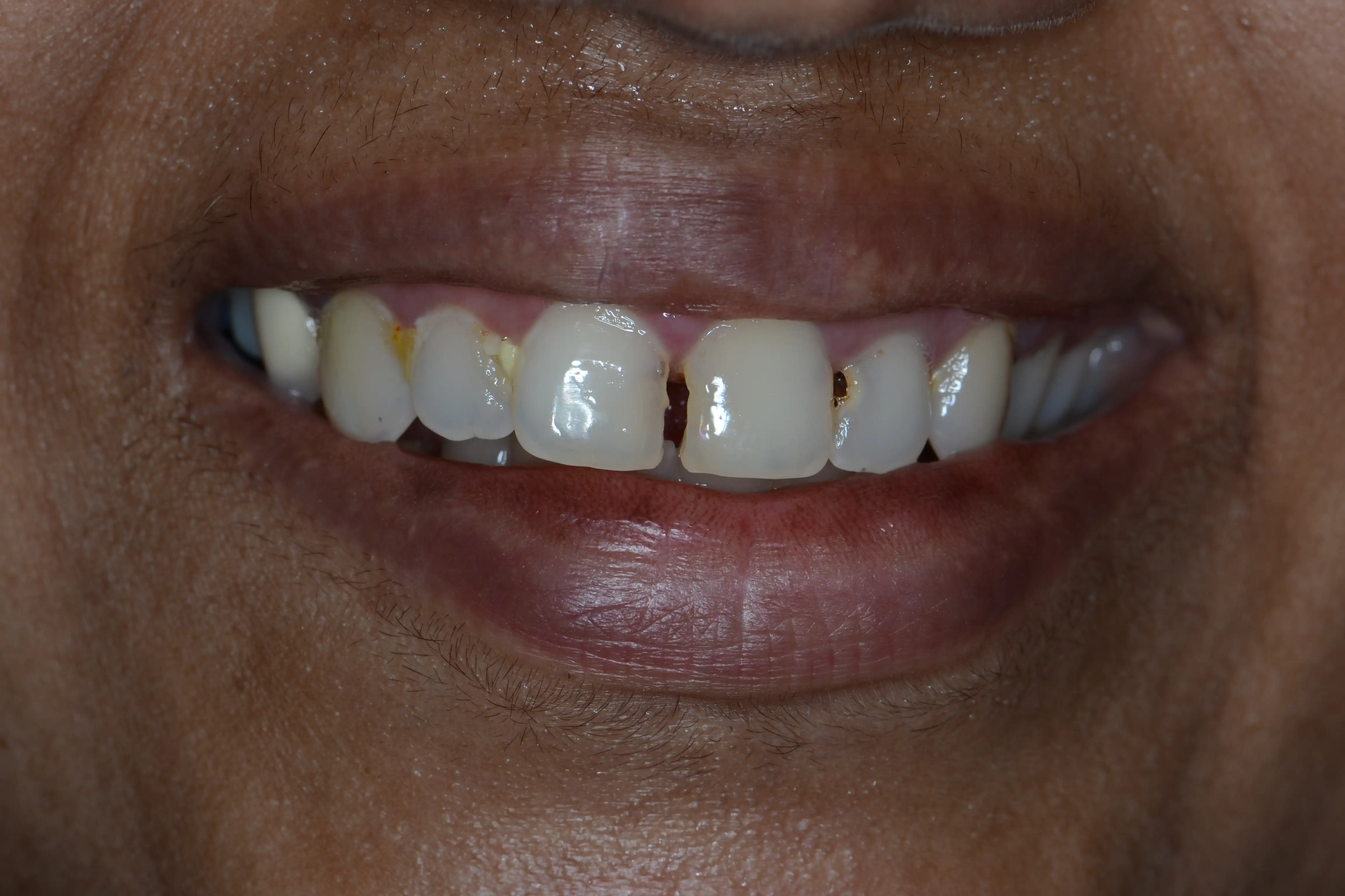 Before treatment