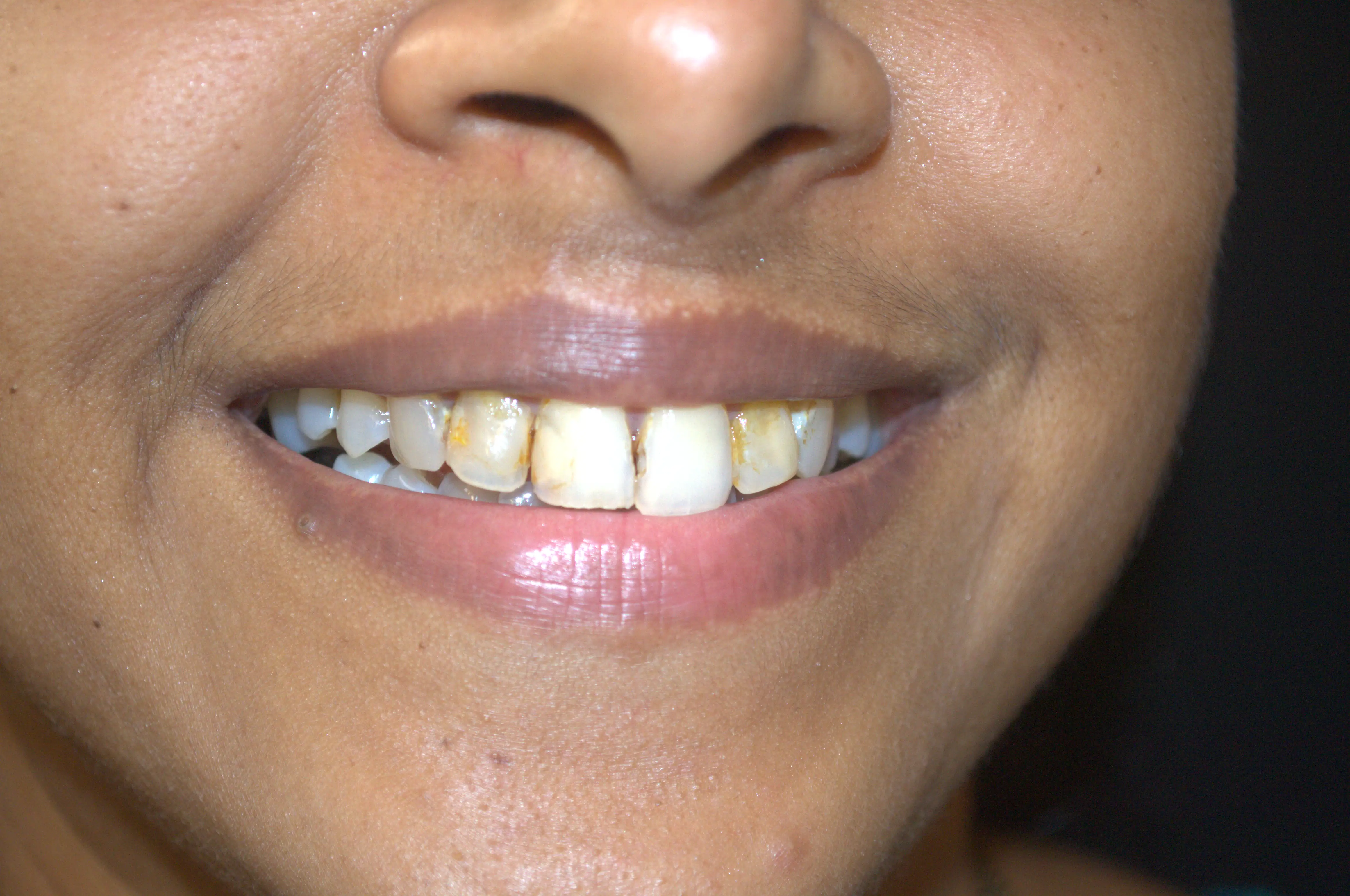 Before treatment