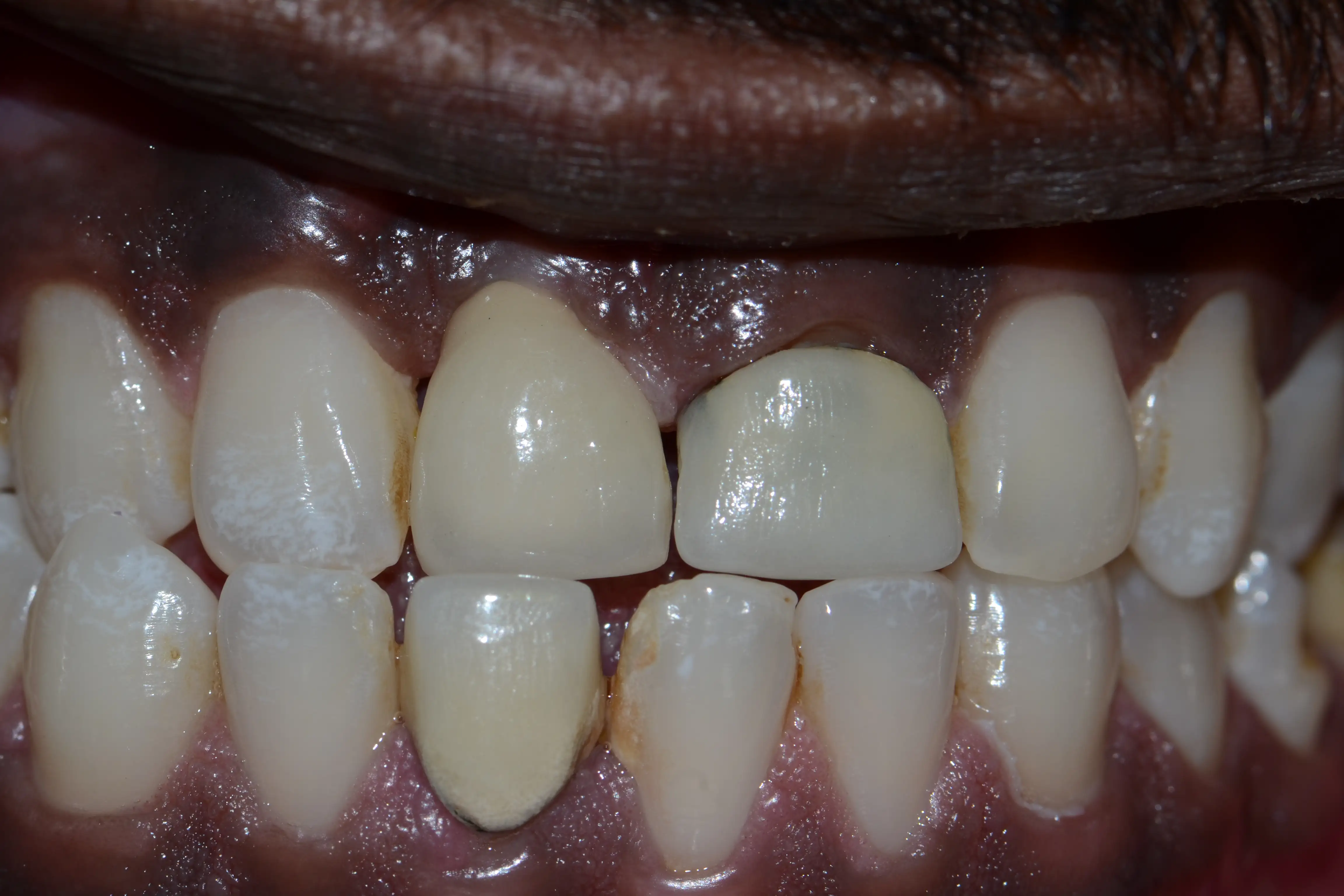 Before treatment