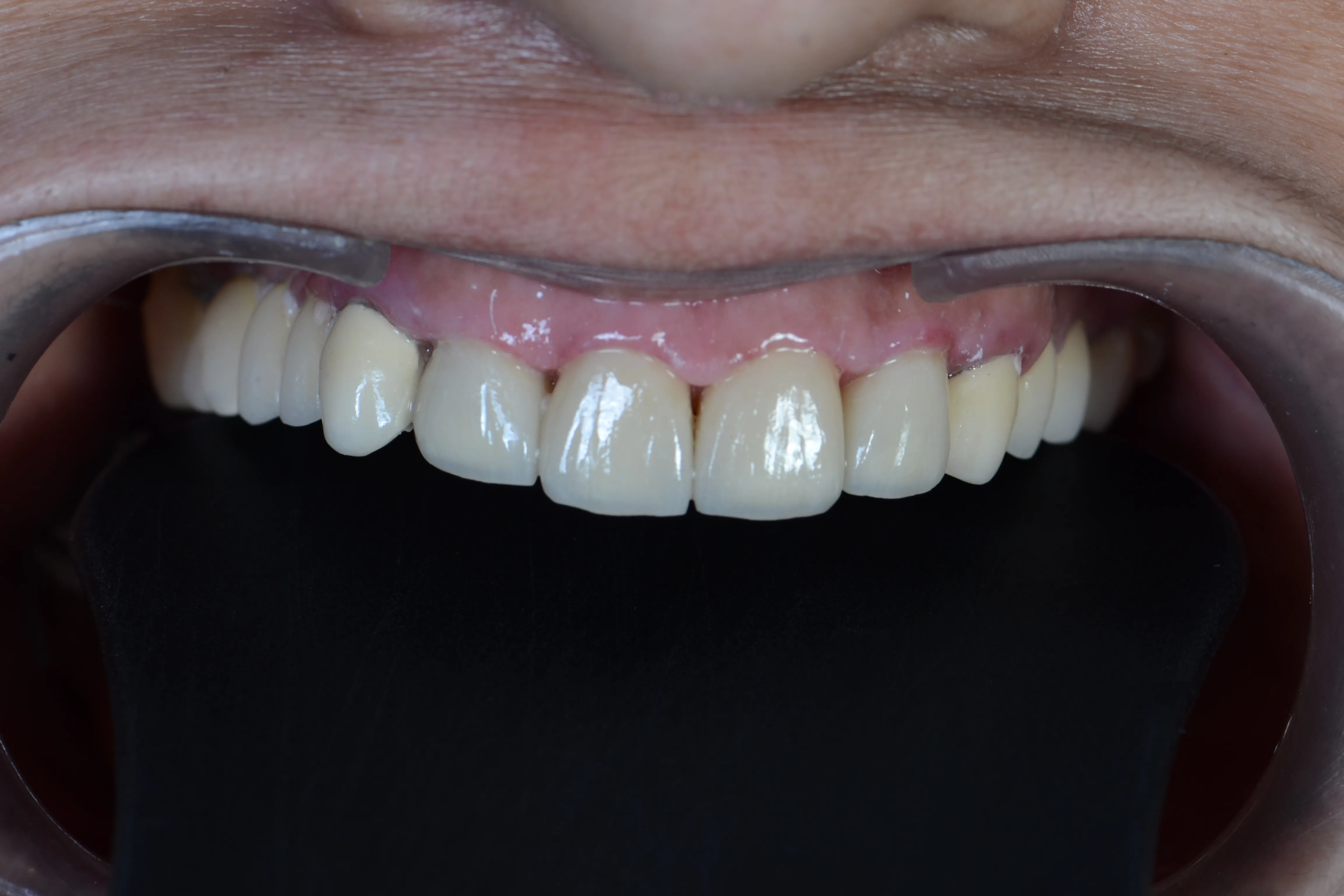 After treatment