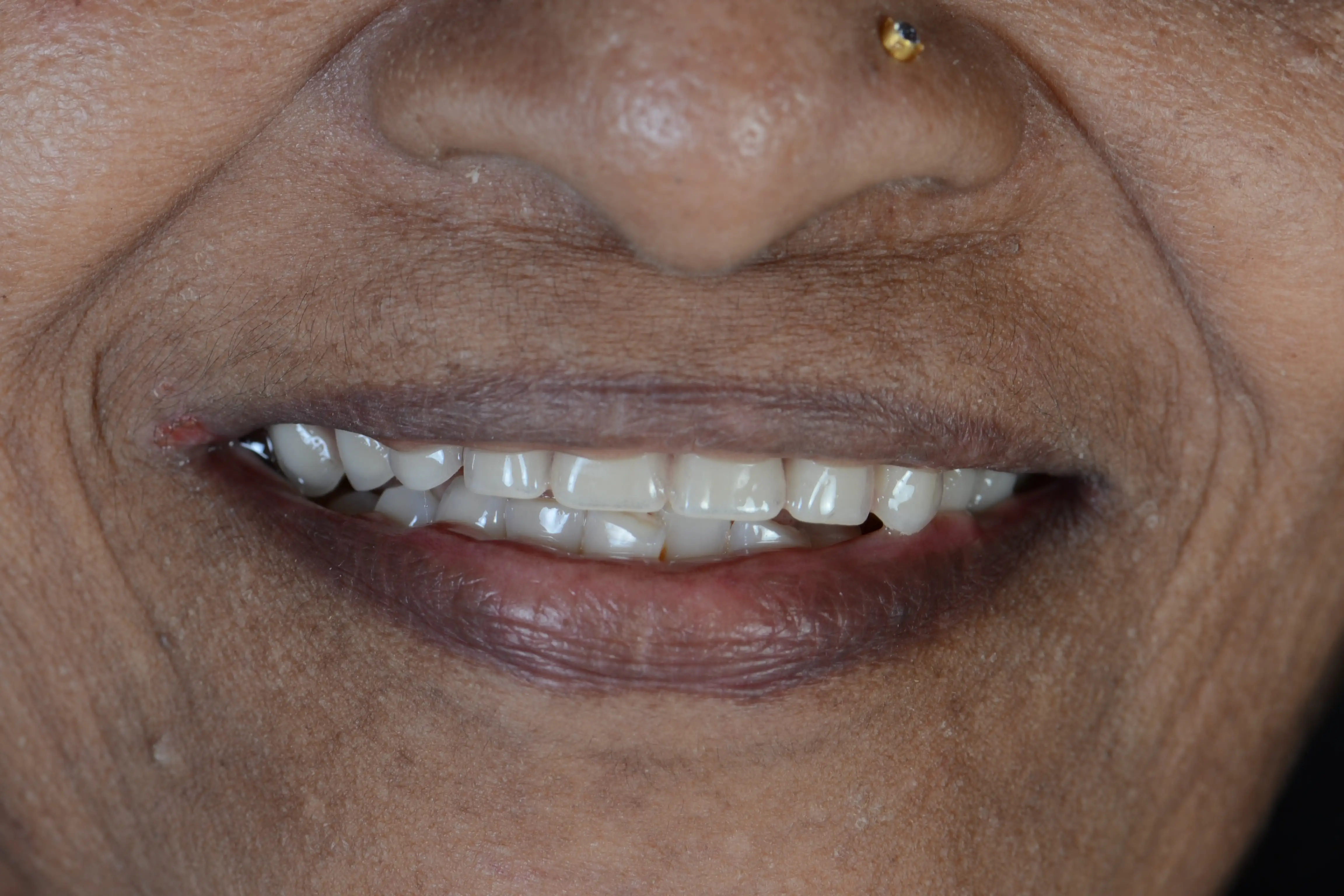 After treatment
