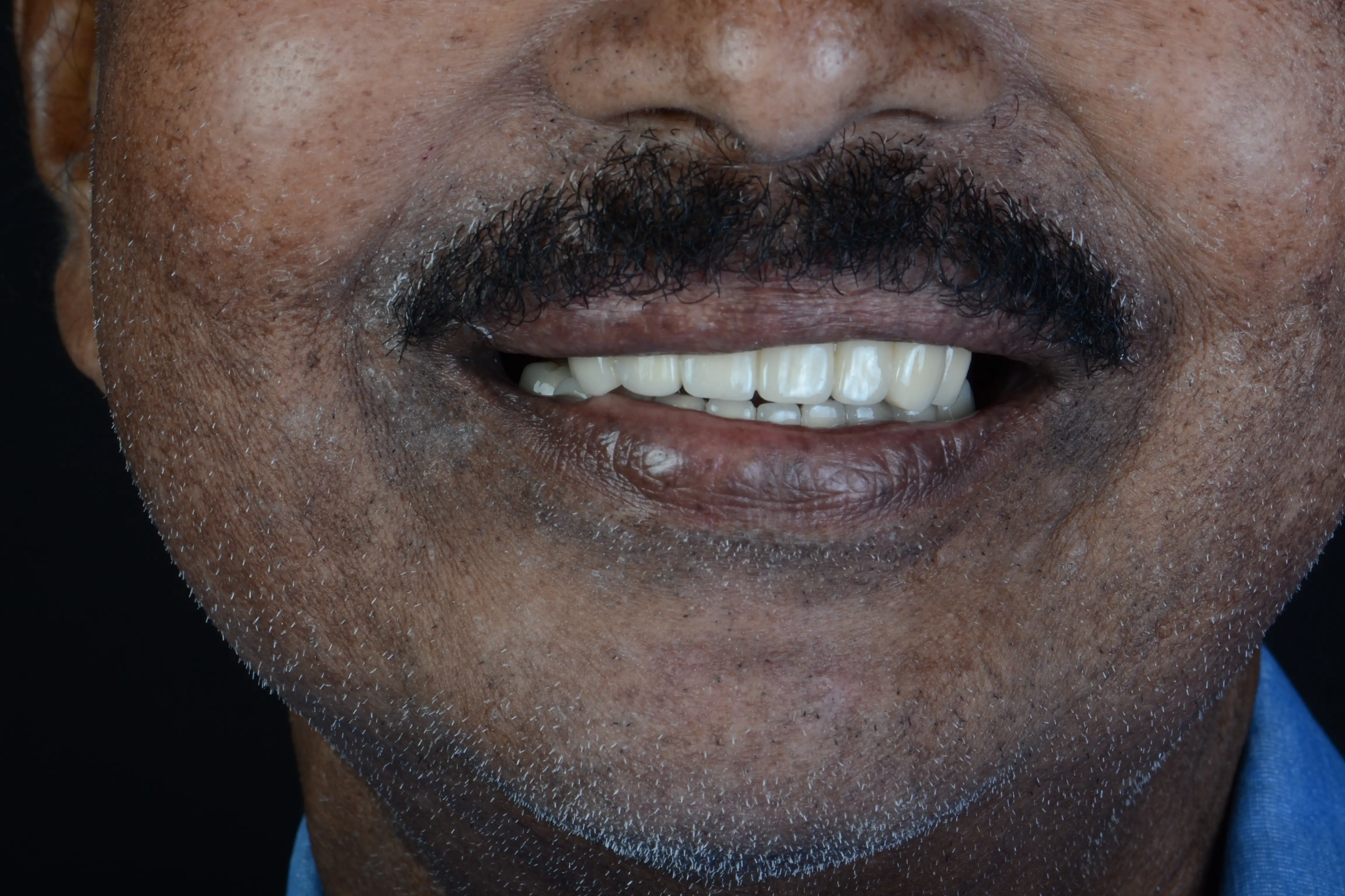 After treatment