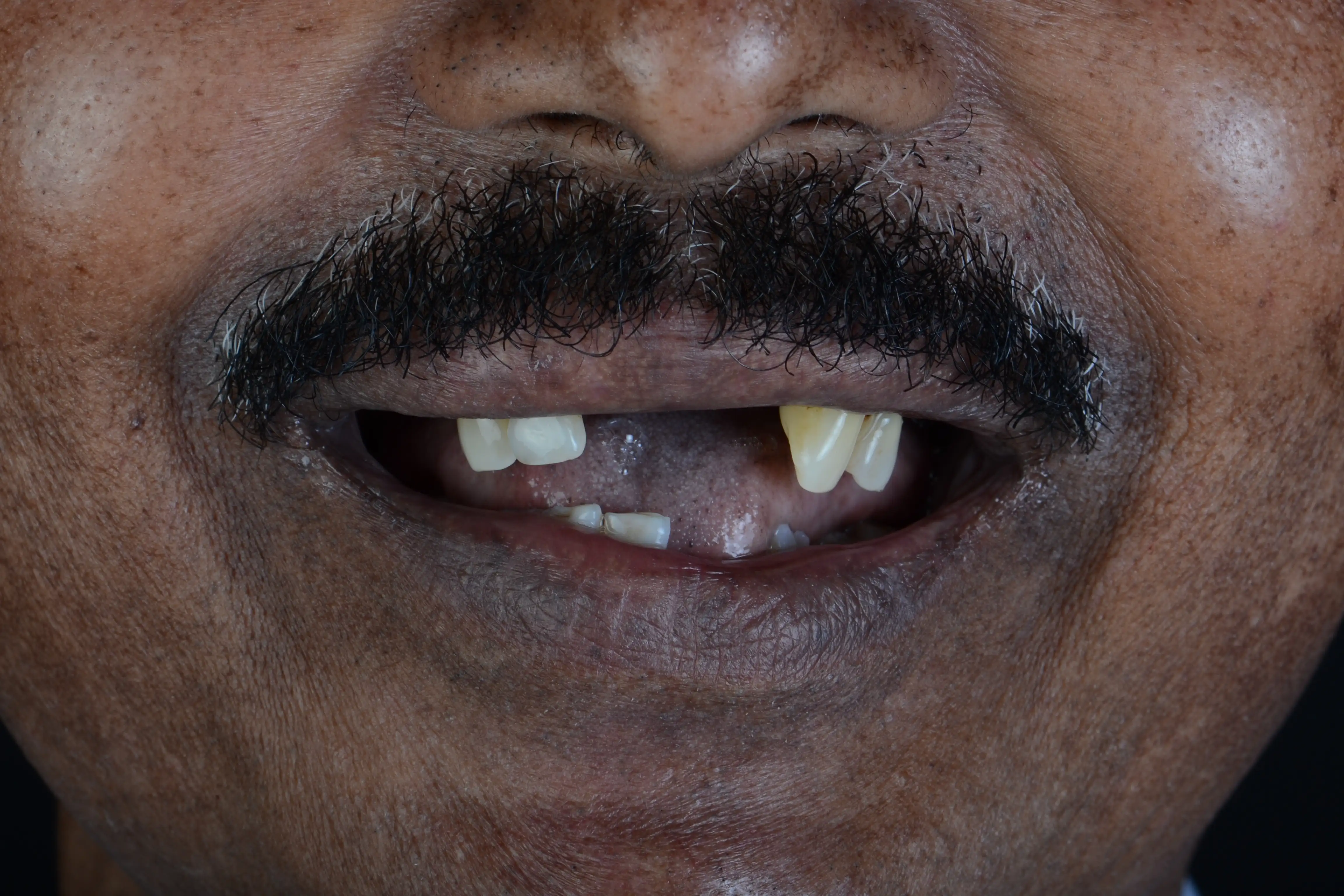 Before treatment