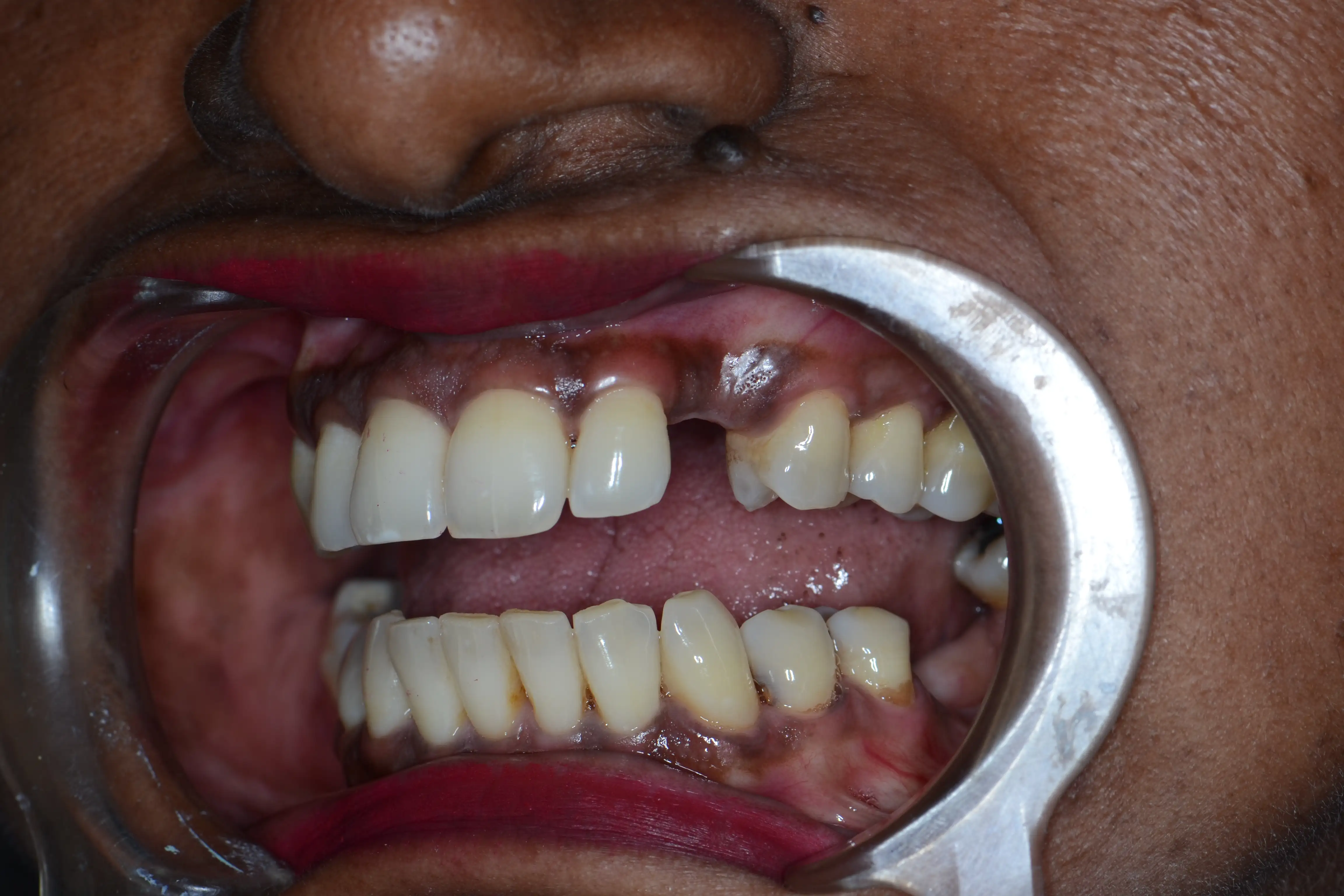 Before treatment