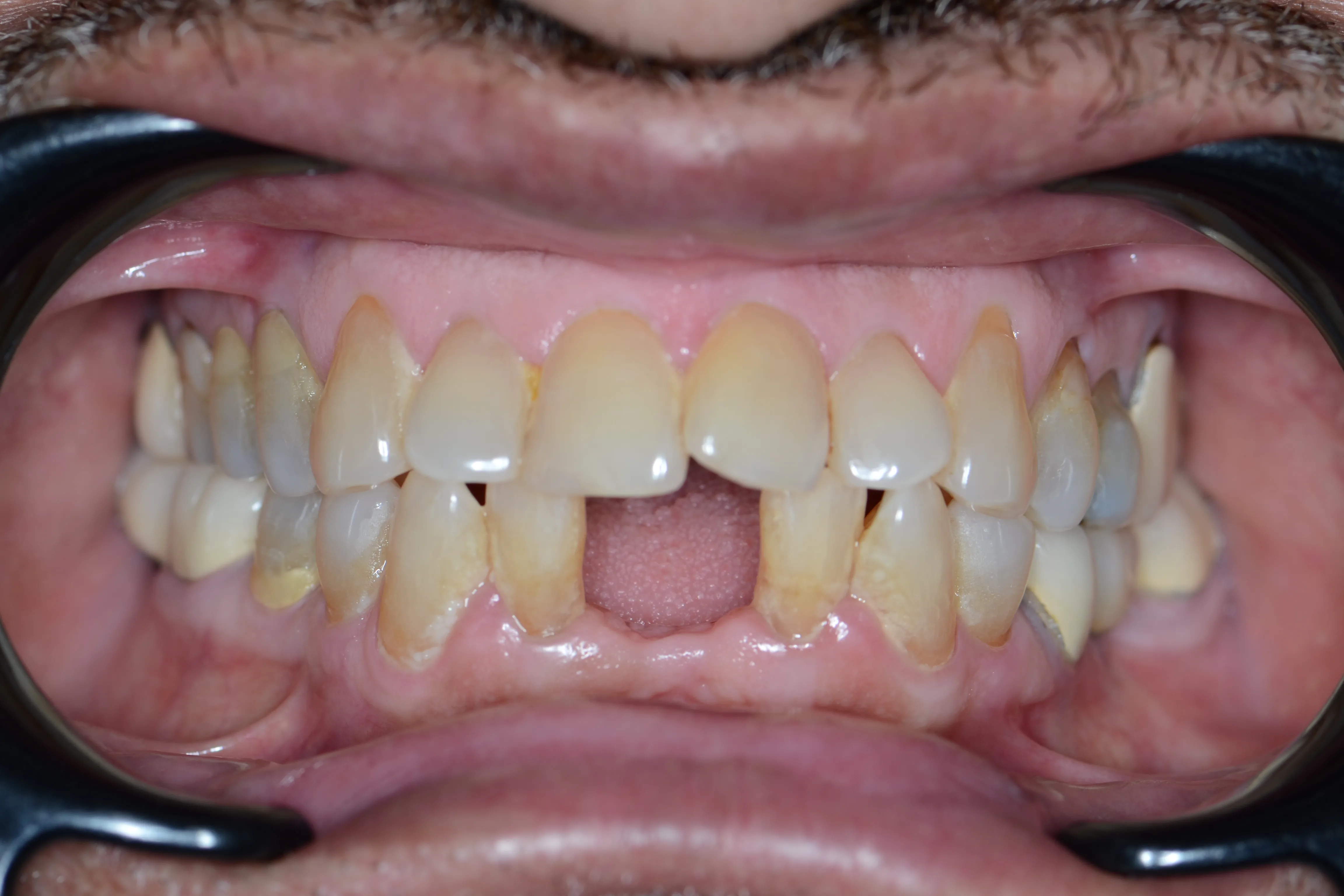 Before treatment