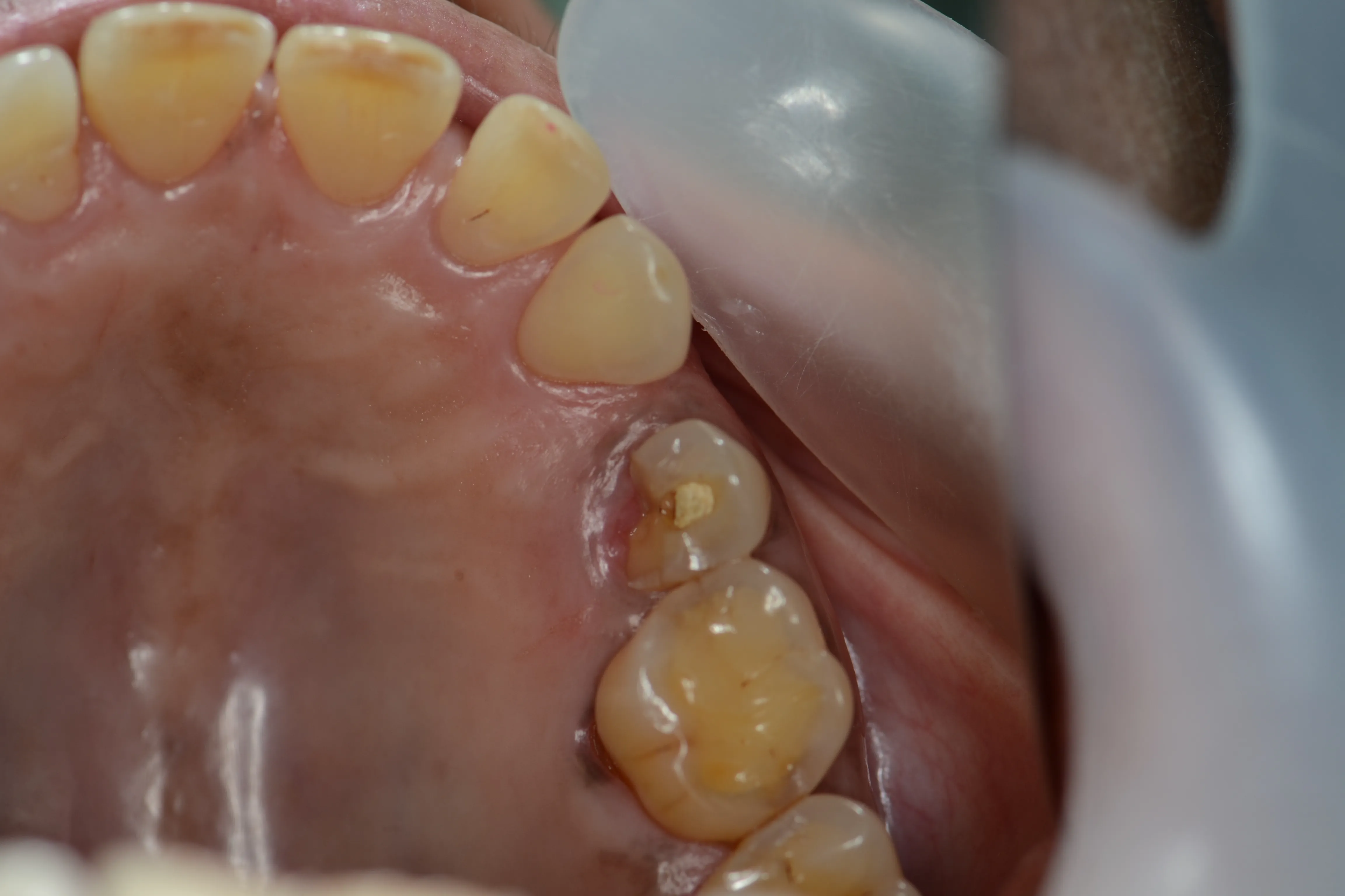 Before treatment