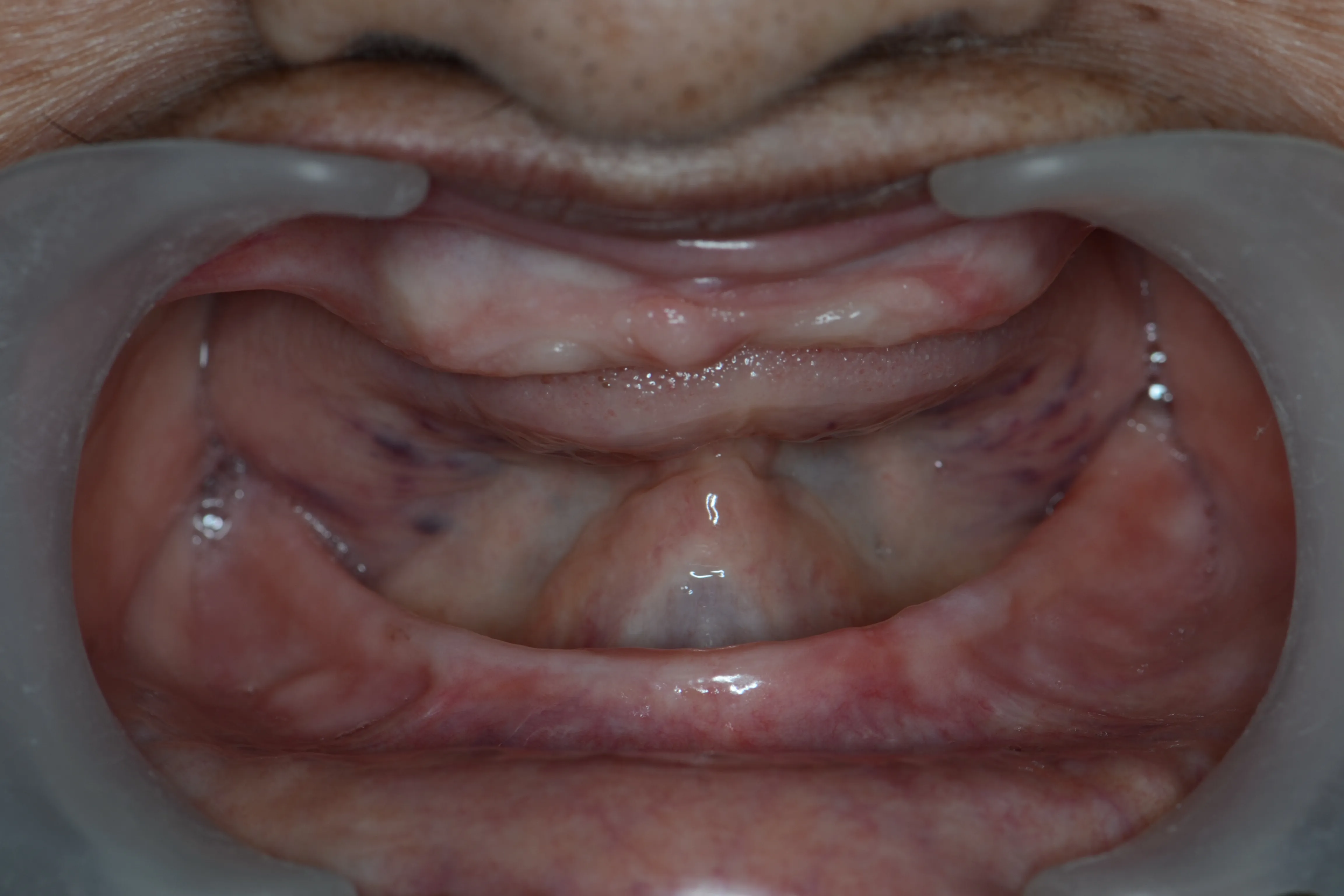 Before treatment