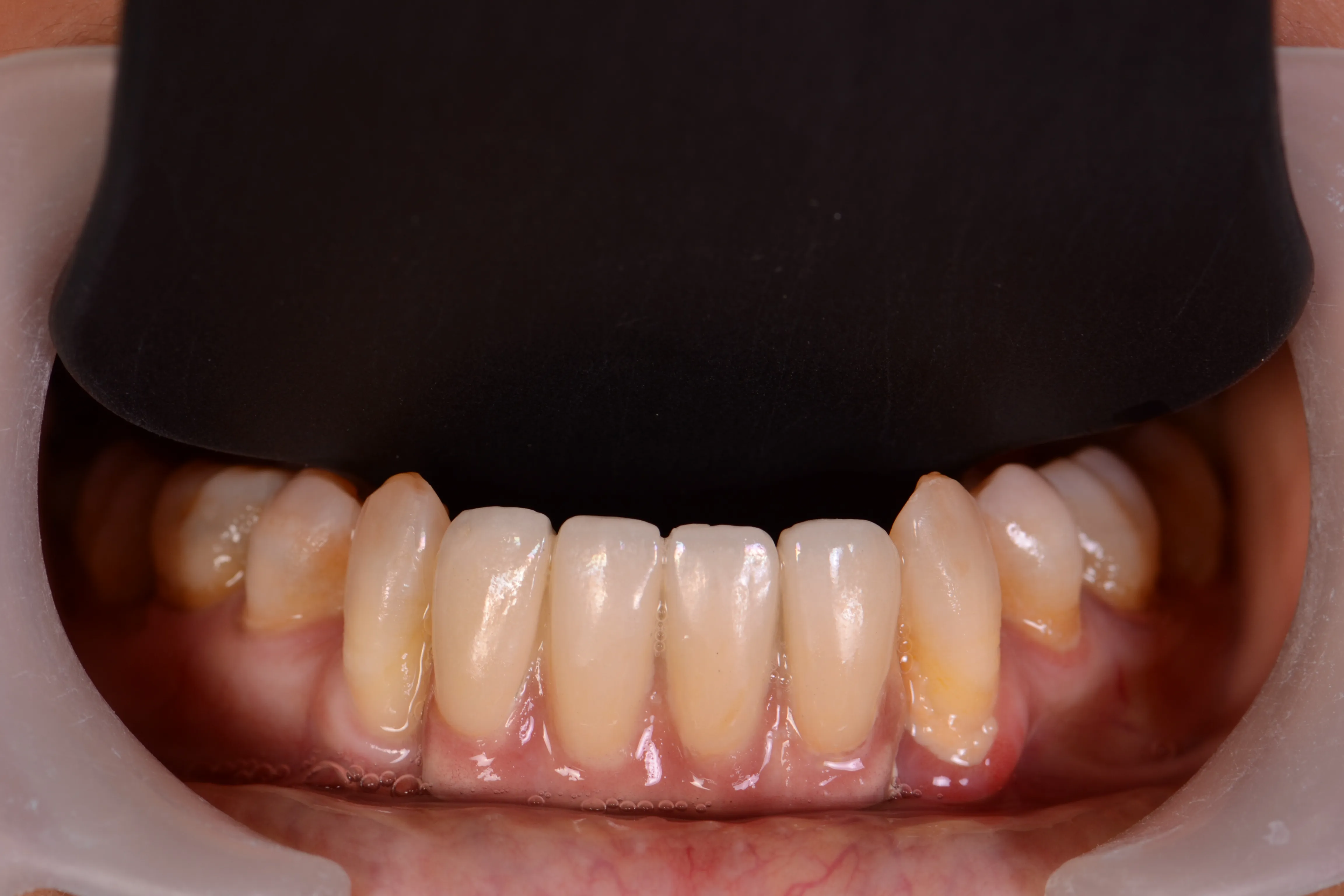 After treatment