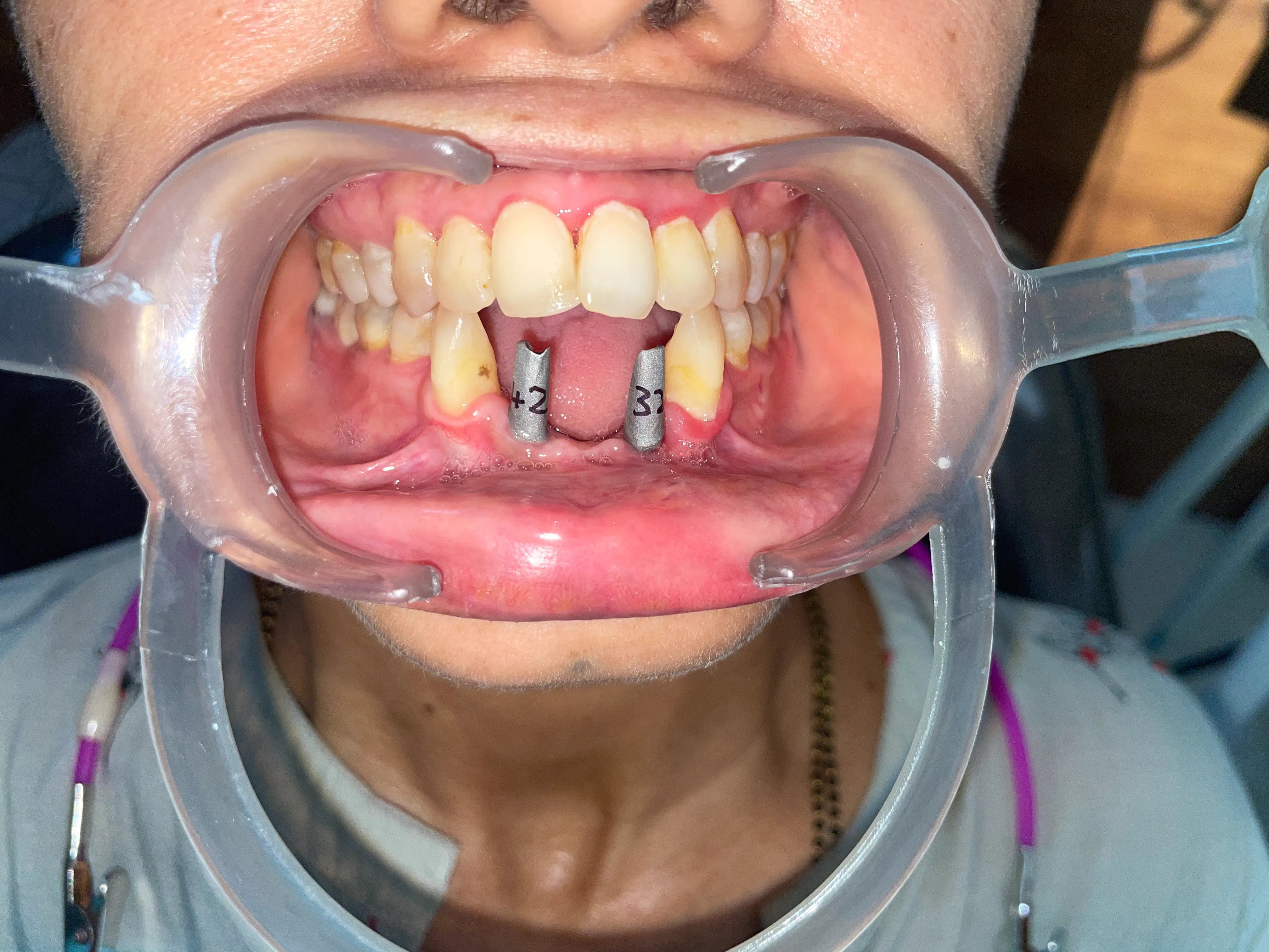 Before treatment